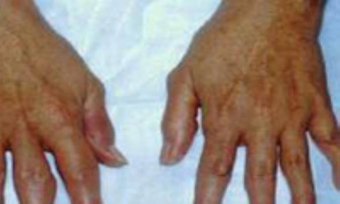 آرتريت روماتوئيد در يک نگاه