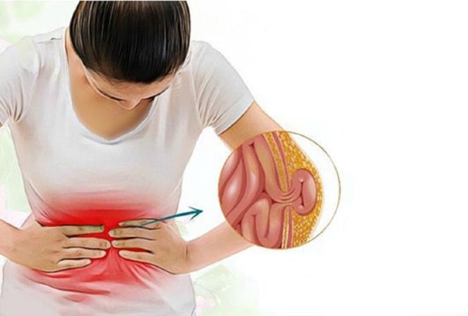 فتق یا باد فتق چیست و  علل، انواع و راه‌های درمان باد فتق