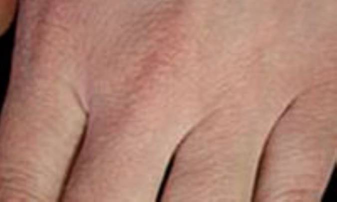 خشكى پوست و خارش زمستانى