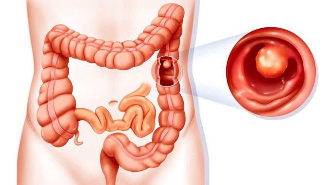از علت تا درمان پولیپ معده