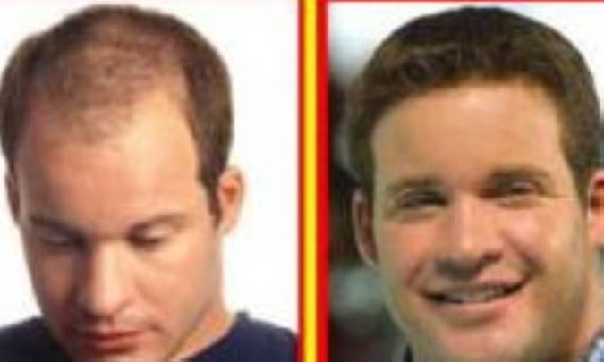 کاشت و پيوند مو به روش Fit و Fut