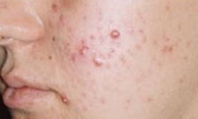 با جاي جوش‌هاي صورت‌ چه کنيم؟