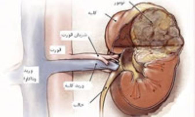 دانستني‌هاي سرطان کليه