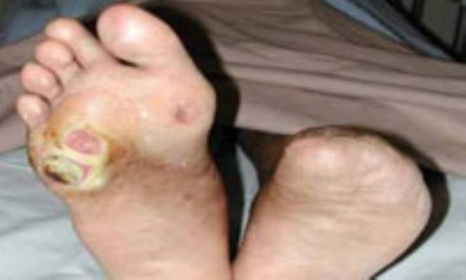 وقتي پاي ديابتي قطع مي‌شود...