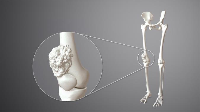 از علت تا درمان تومور استخوان