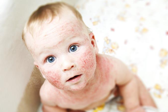 آلرژی  کودکان