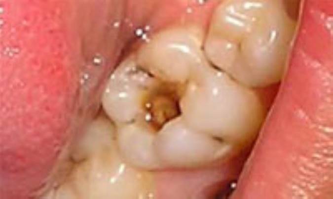 ژلي براي ترميم دندان‌هاي پوسيده