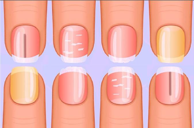 بررسی علل به وجود آمدن خطوط روی ناخن