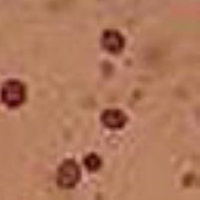 ادرار خونی ( هماچوری )