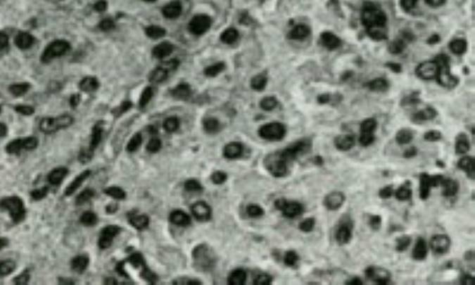 بيماريهاي تخمدان و لوله هاي رحمي (بدخيمي هاي تخمدان)(2)