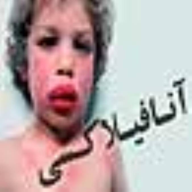 آنافيلاكسي‌ (شوك‌ آلرژيك‌)(Anaphylaxis)