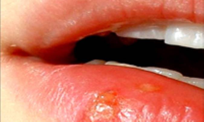 نسخه تبخال را بپيچيد!