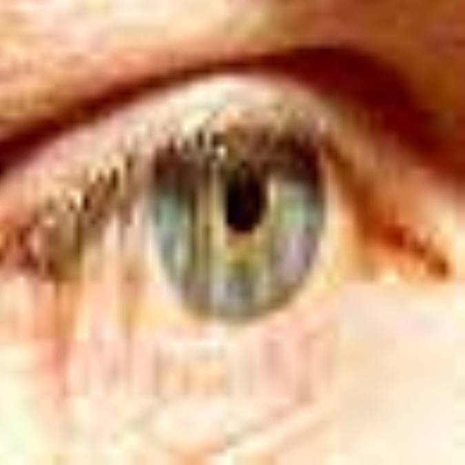 بلفاريت‌ (blepharitis)