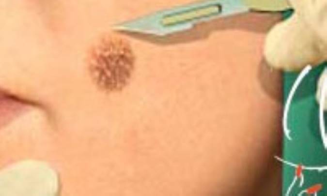 خال را چگونه برمي‌دارند؟