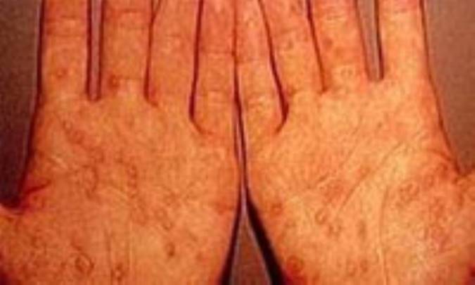 سيفليس چيست؟