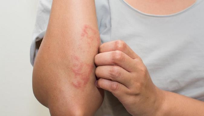 همه چیز راجع به بیماری گال و راه های درمان آن