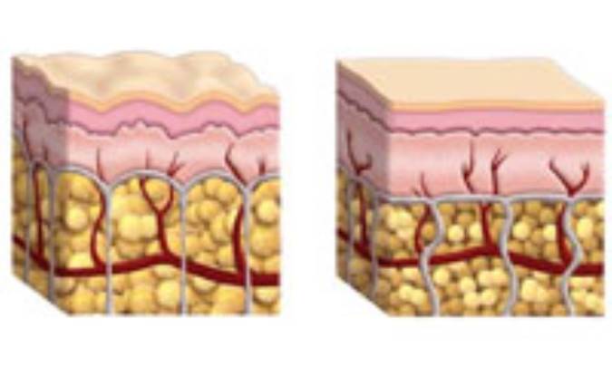 سلوليت يا التهاب سلول‏ها 