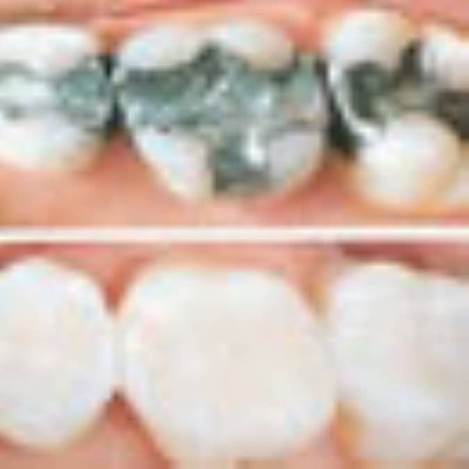 انواع ترميمهاي دنداني 