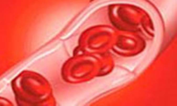 آنچه درباره فيبروم رحمي بايد بدانيد