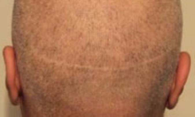 مو با تراشيدن، پرپشت خواهد شد؟