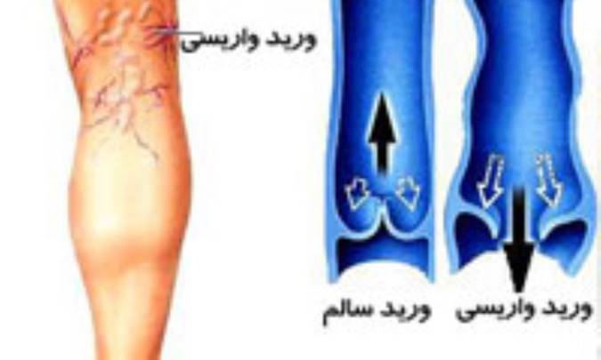 واريس در زنان2 برابر مردان 