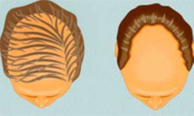 بهترین کاندیدهای پیوند مو 