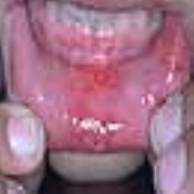 آفت‌ دهان‌(canker sores)