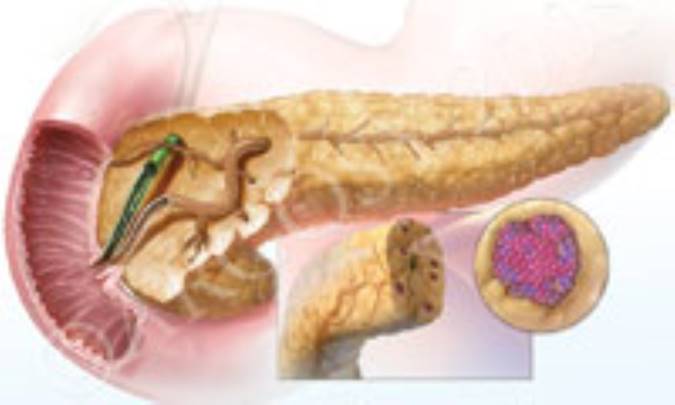 چرا پانکراس ملتهب مي‌شود؟