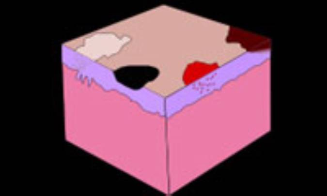 غلبه بر لکه هاي پوستي