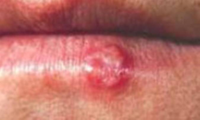 تبِ خالِ لَب