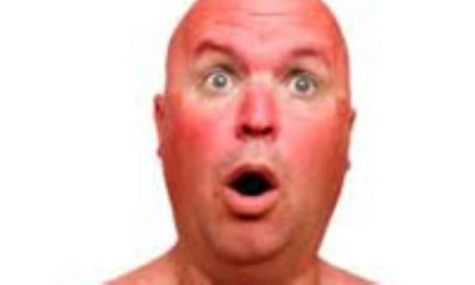 آفتاب سوختگى 