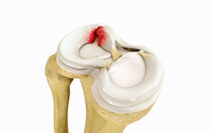 از علت تا درمان پارگی مینیسک