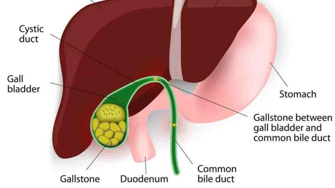 سنگ کیسه صفرا، علل و درمان آن