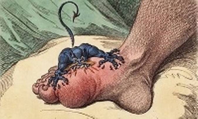 آنچه باید در مورد نقرس بدانید