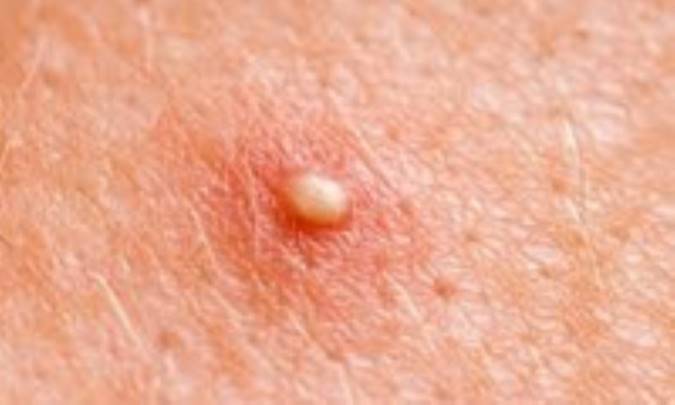 کفگیرک و درمان آن