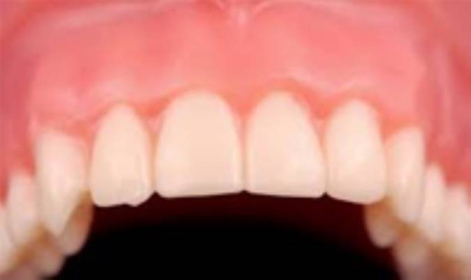 درمان بیماریهای لثه