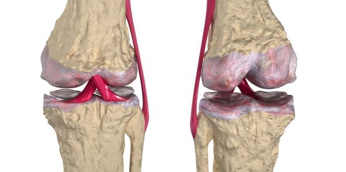 انواع گوناگون بیماری‌های استخوان