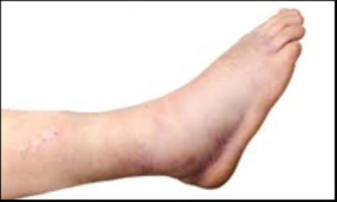 درمان انواع ورم‌ها