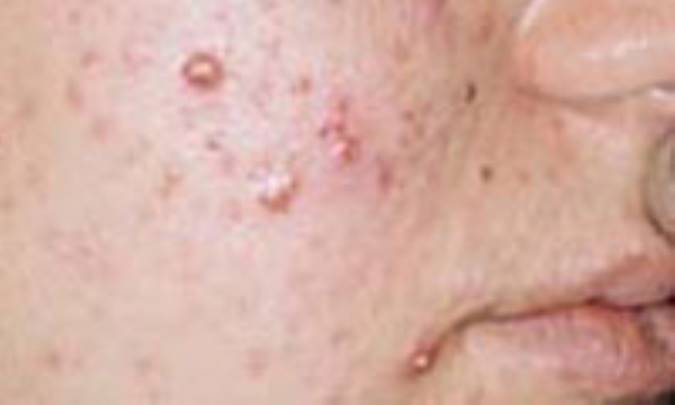 چند راهكار ساده و ارزان برای بهبود جوش‌های صورت