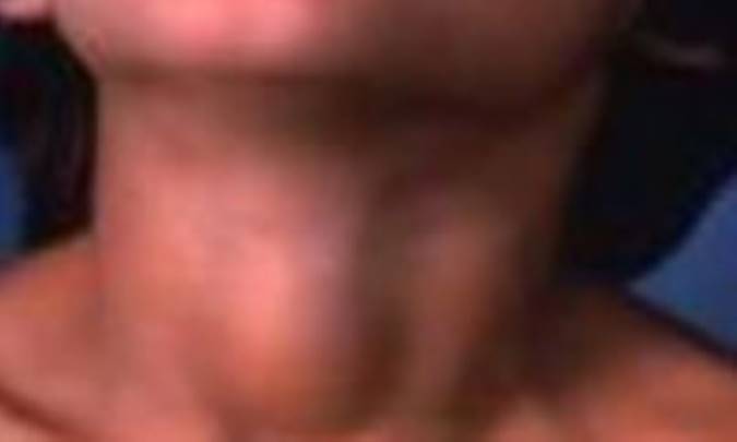 پركاري‌ تيروييد 