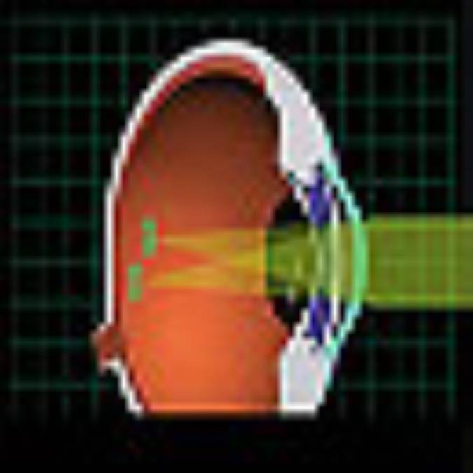 آستیگماتیسم