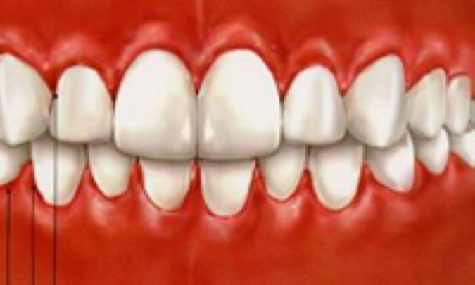 داروهای بزرگ کننده لثه‌ها