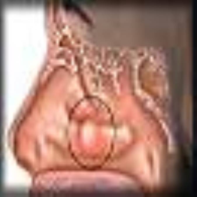 پوليپ هاي بيني