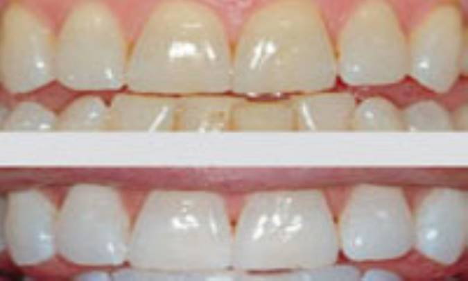 سفيد کردن دندان در مطب يا منزل؟