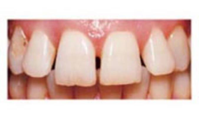 چاره فواصل ميان دندان‌ها