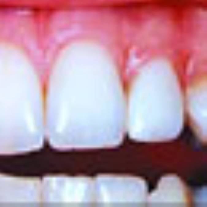 مراقبت از لثه