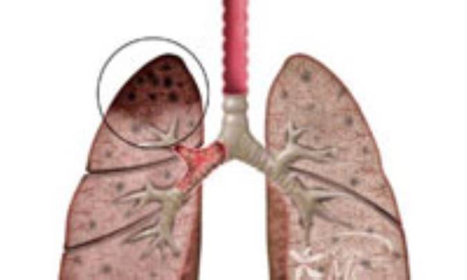 درباره بیماری سل‌ (توبركولوز)