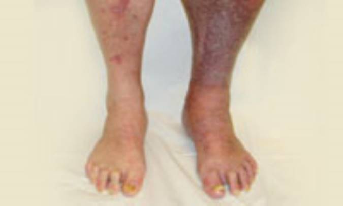 ترومبوز وريد عمقي‌