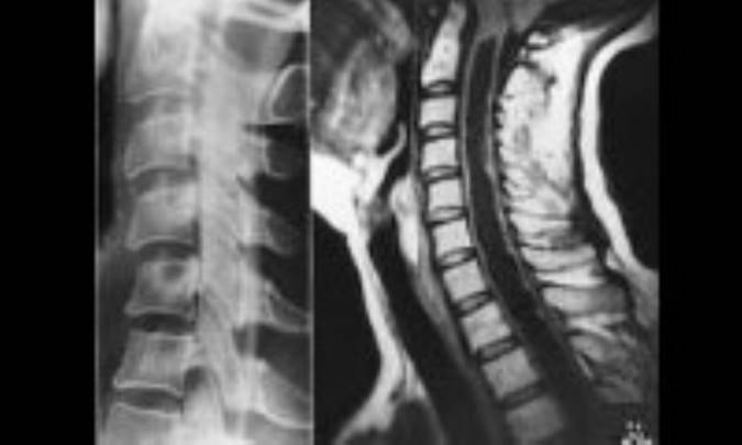 تومور طناب‌ نخاعي
