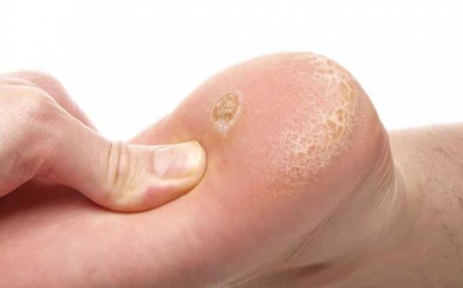 میخچه پا چیست و چگونه درمان میشود؟